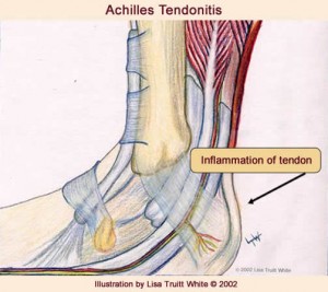 Achilles Tendonitis Indianapolis foot doctor