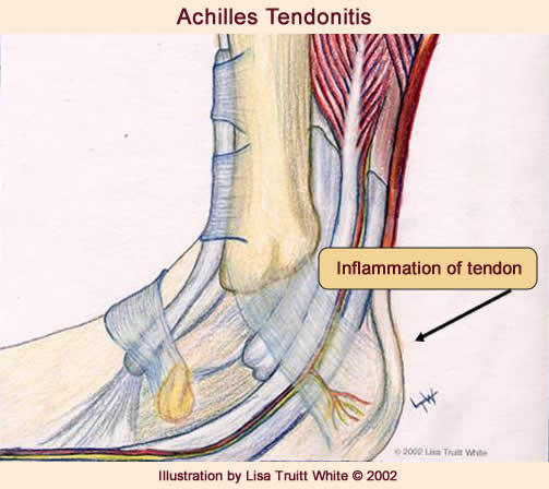 Achilles tendon hot sale after running