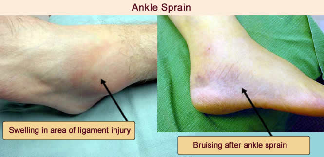 Ankle Sprain  Center Grove Foot & Ankle Care