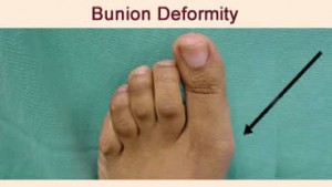 bunion deformity indianapolis foot doctor