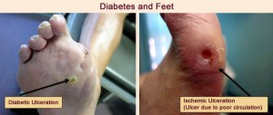 diabetes and feet indianapolis foot doctor