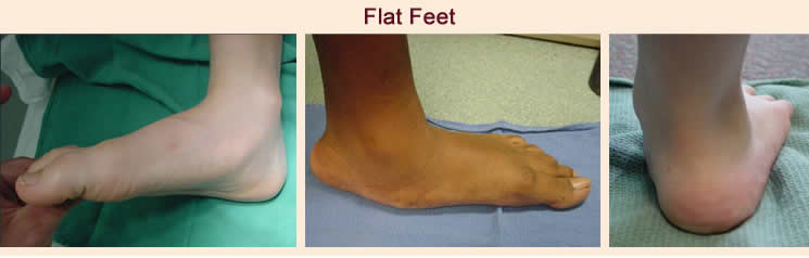 Orthotic Devices : Custom Shoe Inserts 