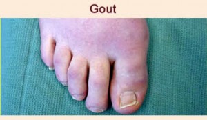 gout footcare indianapolis foot doctor