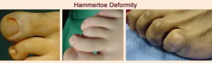 hammertoe care indianapolis foot doctor