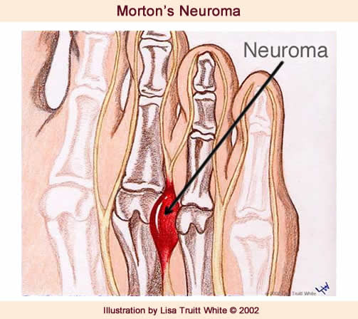 Morton's Neuroma Indianapolis Foot Doctor