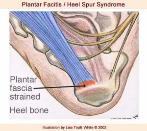 posterior heel pain and plantar fasciitis
