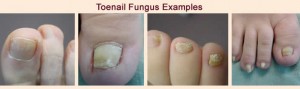 toenail fungus indianapolis foot doctor