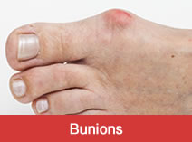 Bunion Treatment Indy Podiatry