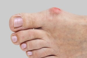 Bunions when to treat