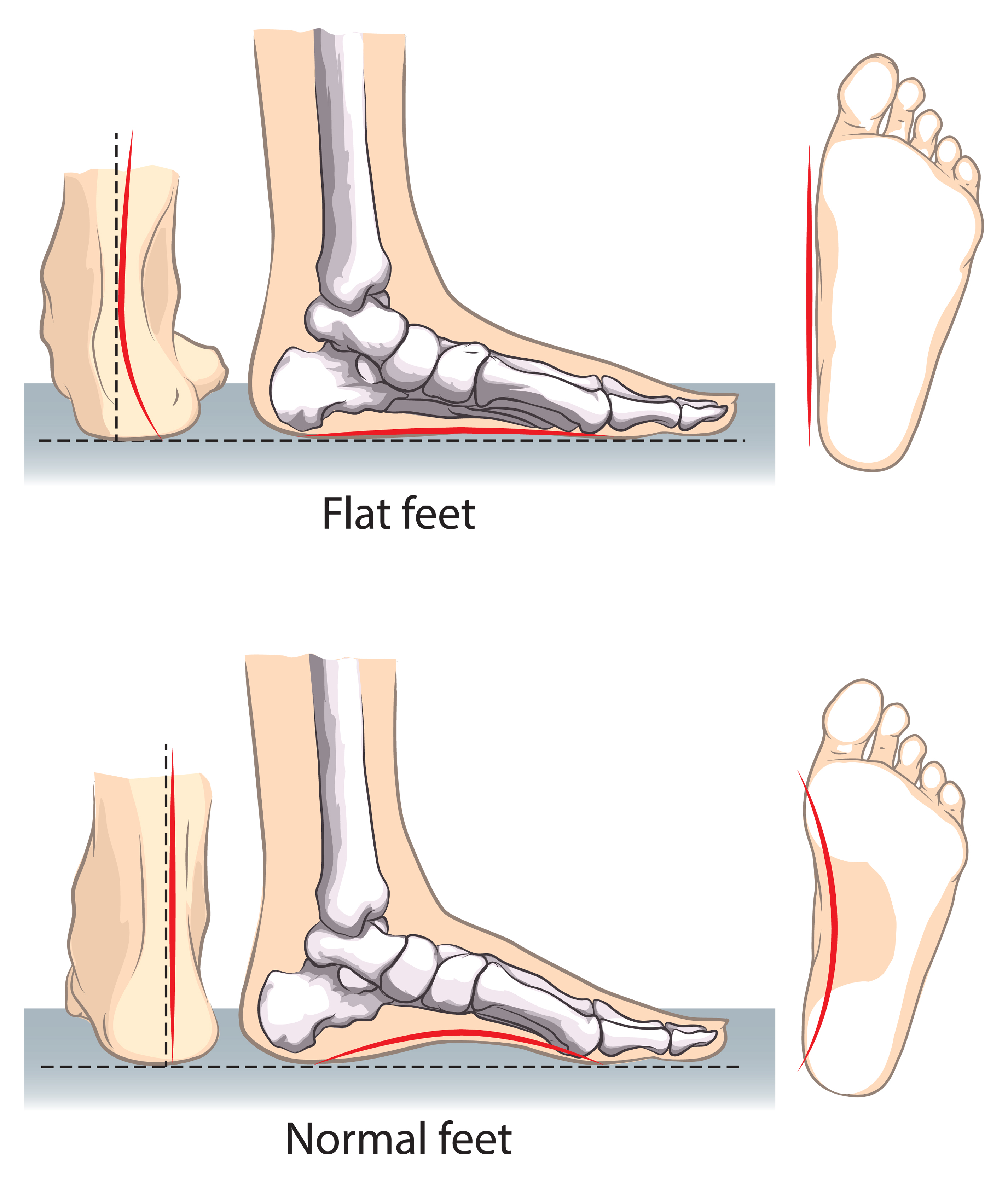 Common Children's Foot & Ankle Problems Indy Podiatry Foot & Ankle